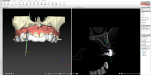 インプラント手術のための精密なシュミレーション